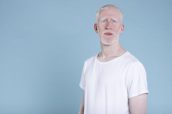 Albinismo - Hombre albino de piel y barba blanca mirando al horizonte