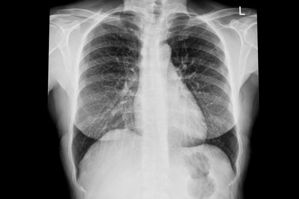 Derrame pleural - Imagen de una radiografía de tórax donde se observan los pulmones