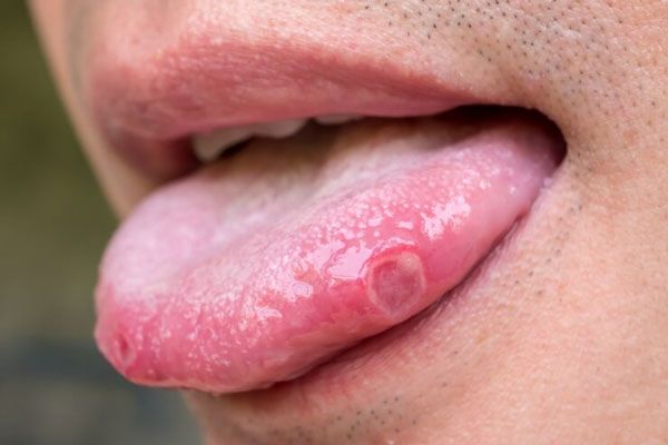 Aftas bucales - Plano detalle de una llaga en la lengua de un hombre