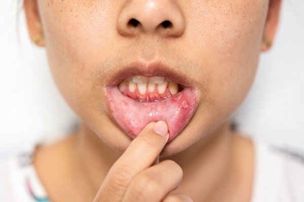 Aftas bucales - Joven sostiene su labio inferior para mostrar un par de lesiones en la mucosa oral