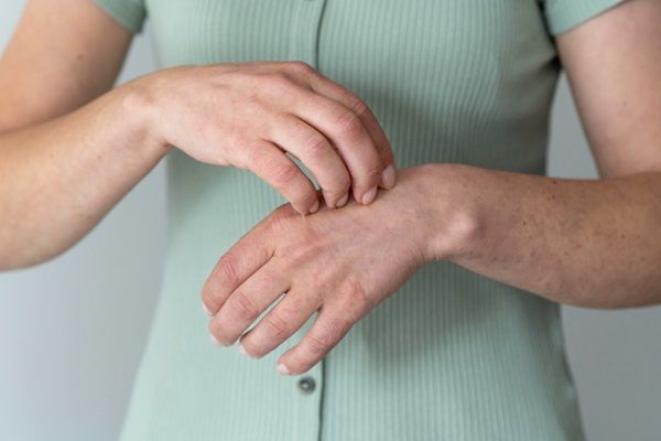 Descripción: Dermatomiositis – Mujer rascándose las manos debido a la picazón que genera las lesiones cutáneas