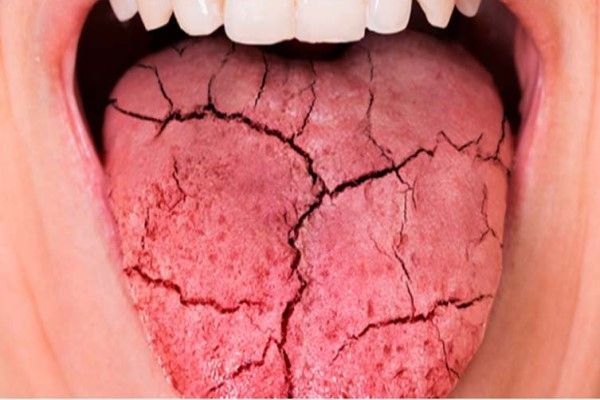 Síndrome de Sjögren - Persona con la lengua seca y agrietada debido a problemas en las glándulas que producen saliva