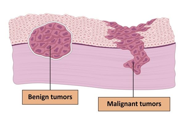 Imagen comparativa de un tumor benigno y un tumor maligno en los tejidos de la piel