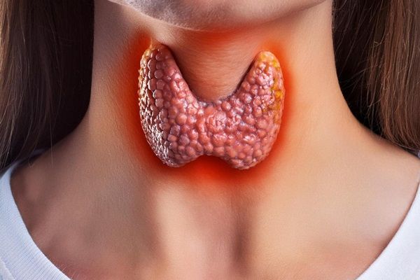 Enfermedad de Hashimoto dieta - Imagen de la glándula tiroide ubicada en el cuello de una mujer