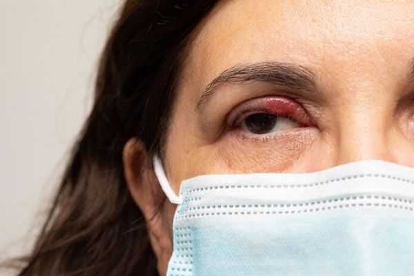 Mujer con orzuelo en el párpado usa tapabocas para protegerse de agentes contaminantes