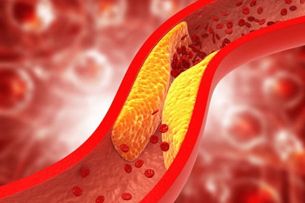 Insuficiencia cardíaca- muestra de arterias tapadas