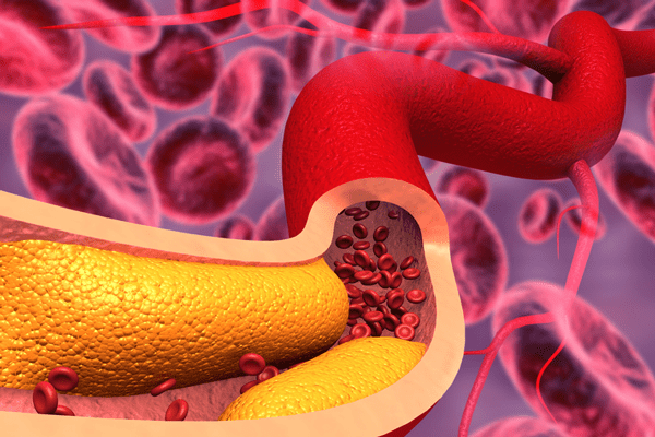 Gráfico que muestra cómo el exceso de grasas saturadas puede obstruir las arterias, dificultando el flujo sanguíneo