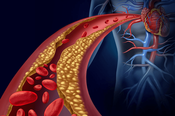 Colesterol bueno y malo - Representación visual de los niveles de colesterol en el cuerpo