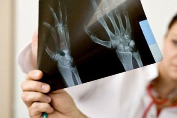 traumatóloga revisando una radiografía para comprobar los daños en la muñeca