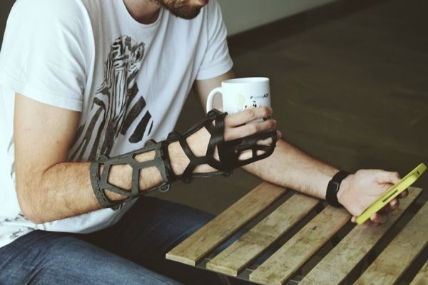Metacarpianos y falanges - hombre con una férula para inmovilizar la mano por una fractura de los metacarpianos y falanges