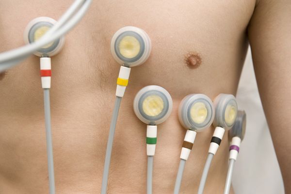 infarto teniendo marcapasos- Revision de paciente que tiene un marcapasos