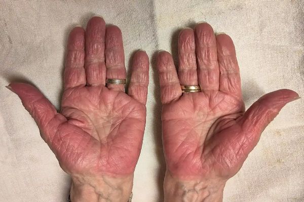 Eritromelalgia - Mujer mayor muestra las palmas de sus manos enrojecidas