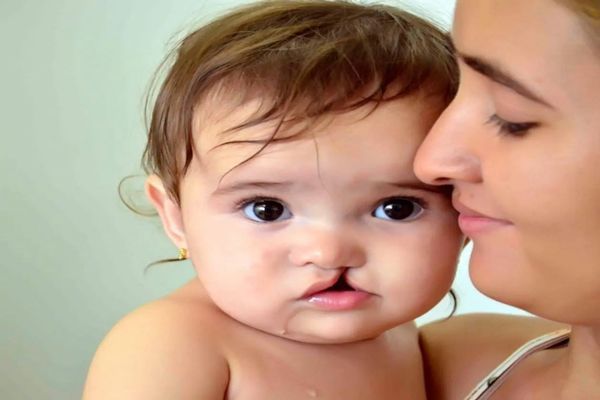 Síndrome de DiGeorge - Madre carga a su hijo con labio hendido