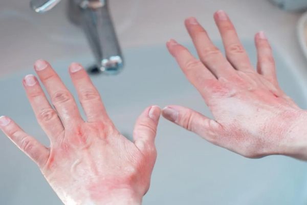 Eritromelalgia - Mujer estira al aire sus manos enrojecidas