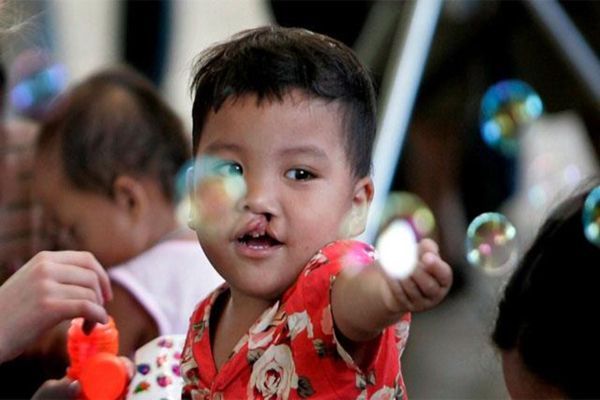 Síndrome de DiGeorge - Niño moreno con labio leporino jugando con burbujas en el aire