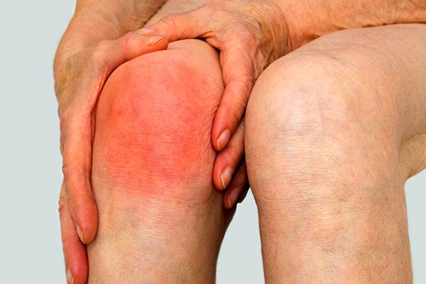 Staphylococcus aureus - Mujer mayor sujeta su pierna tras presentar un persistente dolor en la rodilla