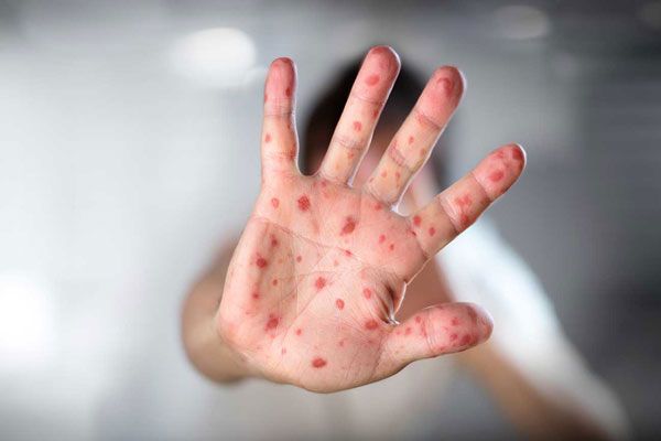 Sarampión - Mano extendida como símbolo de stop contra las infecciones virales y como un llamado a la consciencia ante la vacunación
