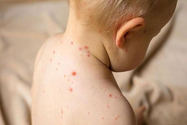 Sarampión - Bebé con erupción cutánea en la espalda y en parte del cuello