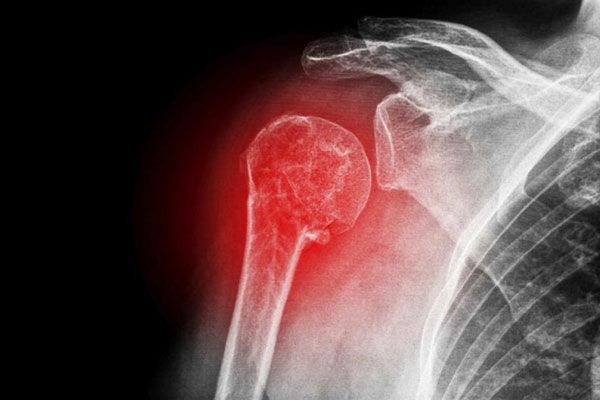 Osteogénesis - Radiografía de una emergencia ósea, muscular y articular