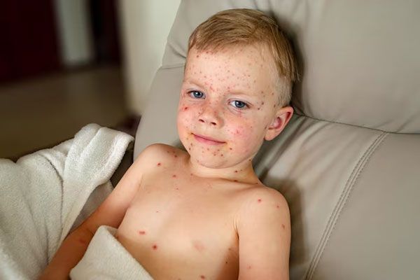 Niño con sarpullido rojo en el rostro toma un descanso en el sofá para recuperarse más rápido de una infección viral