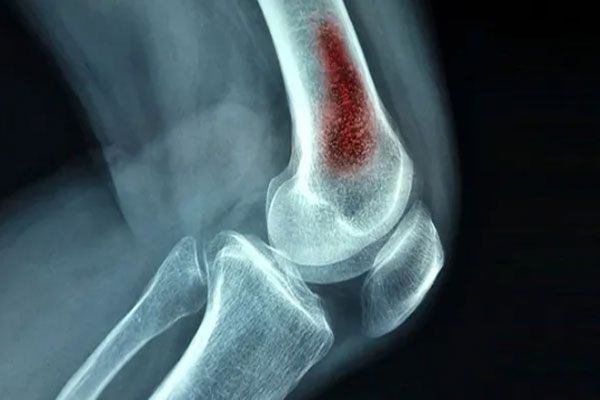 Staphylococcus aureus - Radiografía de brazo da muestra de una incipiente lesión en los huesos