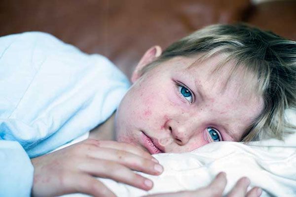Sarampión - Niño en cama recuperándose de una infección viral con sarpullido localizado