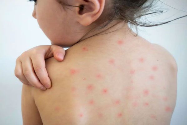 Sarampión - Niña con sarpullido generalizado en la espalda como parte de los síntomas de una enfermedad viral