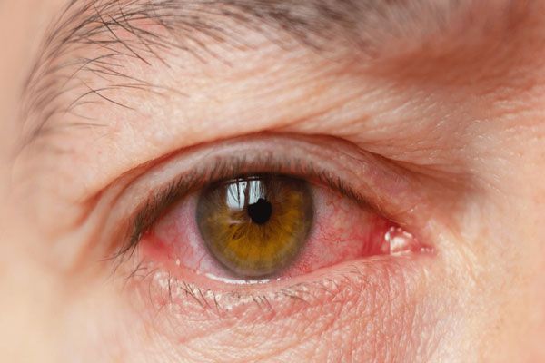 Pseudomonas aeruginosa - Hombre con ojo visiblemente enrojecido como parte de los efectos colaterales de una infección bacteriana