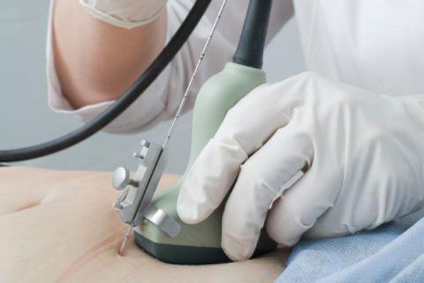 Ginecólogo toma todas las medidas pertinentes para realizarle una amniocentesis a una paciente embrazada