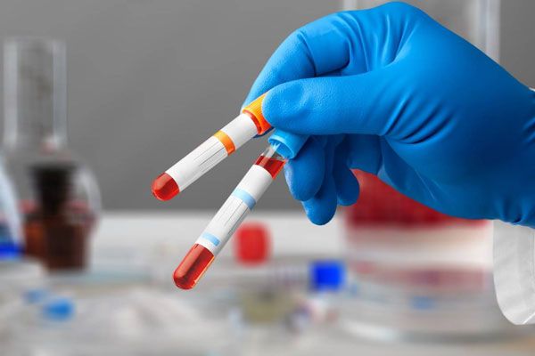 Densidad ósea - Bioanalista etiqueta tubos de ensayo con muestras de sangre para su posterior análisis 