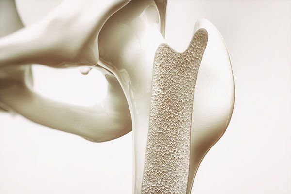 Vista ampliada de hueso con proceso incipiente de osteoporosis 