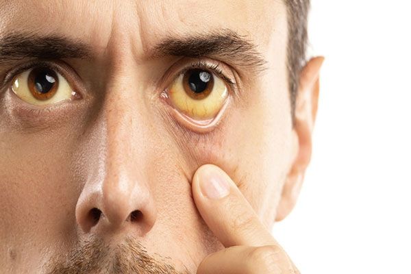 Tipos de hepatitis - Hombre con problemas en el hígado muestra como sus ojos se han empezado a tornar de un color amarillento