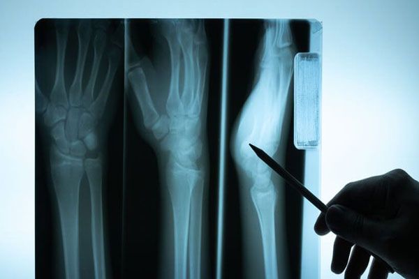 Osteomielitis - Doctor señala las parte comprometidas de una mano con ayuda de una radiografía en tres partes