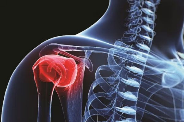 Osteomielitis - Radiografía de la parte superior del brazo