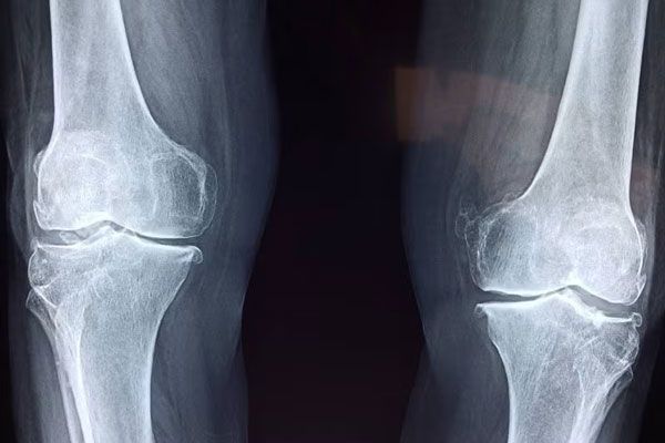 Cáncer de huesos - Radiografía da cuenta de ciertas irregularidades en la estructura ósea de un paciente