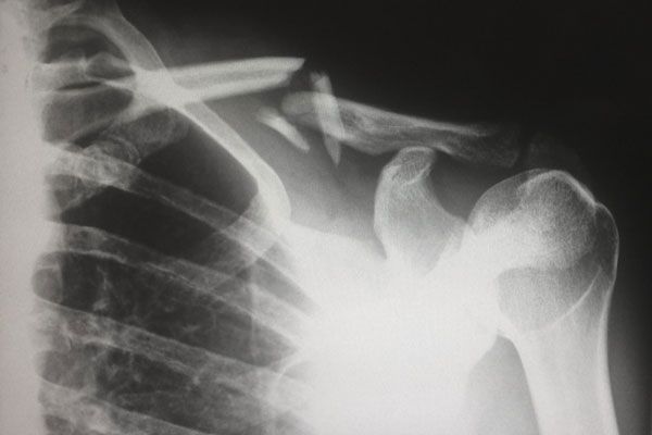 Osteogénesis imperfecta - Radiografía da muestra de una grave fractura en el hombro de un paciente