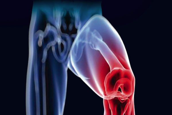 Osteomielitis - Inflamación de las articulaciones de la rodilla por infección bacteriana