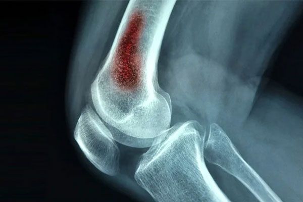 Osteomielitis - Hueso del codo visiblemente afectado por una lesión que demanda de atención médica