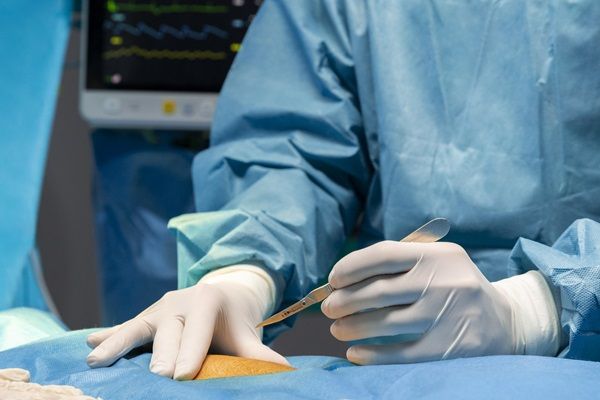 Osteonecrosis - Doctor realizando una cirugía en la rodilla de un paciente, para tratar la enfermedad en los huesos llamada osteonecrosis
