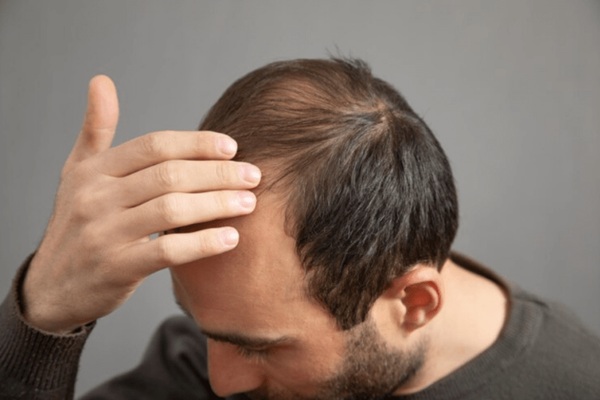 Tipos de alopecia - Hombre pensativo con calvicie avanzada analizando si debe visitar las mejores clínicas injerto capilar Madrid