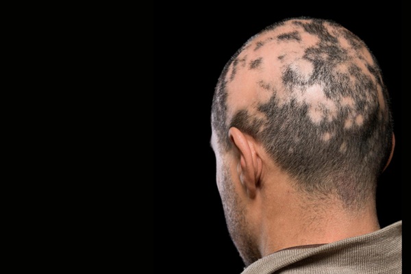 Tipos de alopecia - Hombre con alopecia areata que provoca la caída del cabello en parches la cual se puede tratar en las mejores clínicas injerto capilar Madrid