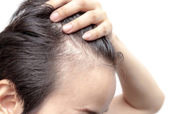 Tipos de alopecia - Hombre con alopecia difusa debido al estrés que causa calvicie temporal