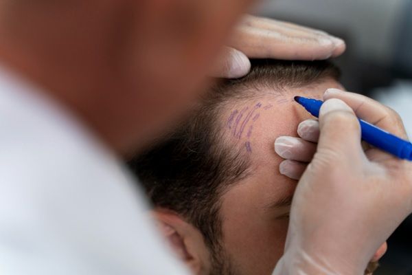 Injerto capilar Madrid - Médico tricólogo realizando el boceto del trasplante capilar Madrid a un hombre con alopecia en las entradas