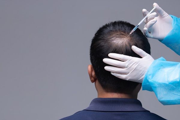 Implante capilar Madrid - Médico estético realizando un tratamiento de injerto capilar Madrid a un hombre con alopecia en la coronilla