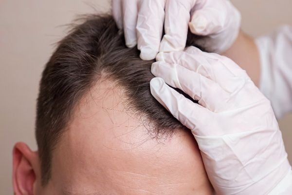 Implante capilar Madrid - Médico evaluando el cuero cabelludo de un hombre con alopecia para determinar el precio injerto capilar