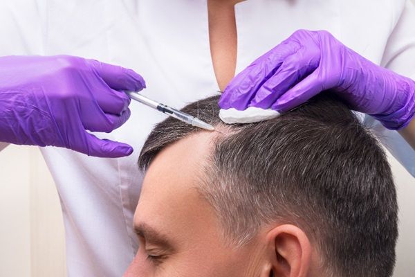 Implante capilar Madrid - Médico especialista realizando un injerto capilar Madrid a un hombre con alopecia en una de las mejores clínicas injerto capilar Madrid