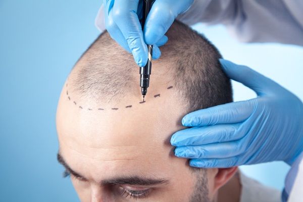 Técnicas implante capilar Madrid - Tricólogo realizando el boceto del trasplante capilar Madrid a un hombre con pérdida de cabello en las entradas y coronilla