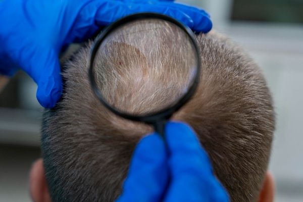 Regeneración de cabello - Médico capilar evaluando el cuero cabelludo de un hombre con alopecia en la coronilla para aplicar biotecnología regeneración de cabello