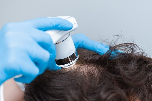 Regeneración de cabello - Tricólogo aplicando una tratamiento de bioingeniería capilar para recuperar el cabello de un hombre con alopecia