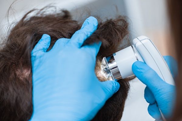 Regeneración de cabello - Tricólogo realizando un tratamiento de medicina capilar a un hombre para detener la caída del cabello
